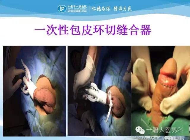 包皮最新手术方法及论述概述
